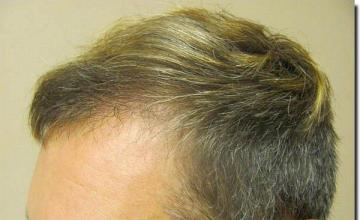 Hair restoration procedure results