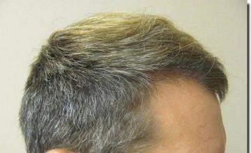 Hair restoration procedure results