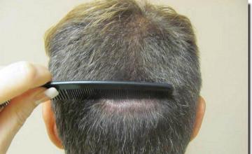 Hair restoration procedure results