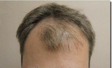 Hair restoration procedure results