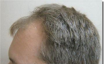 Hair restoration procedure results