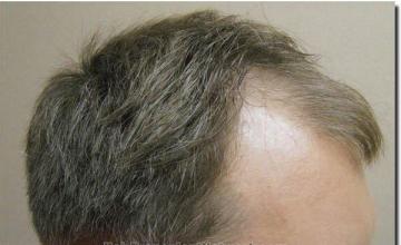 Hair restoration procedure results