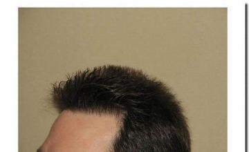 Hair restoration procedure results