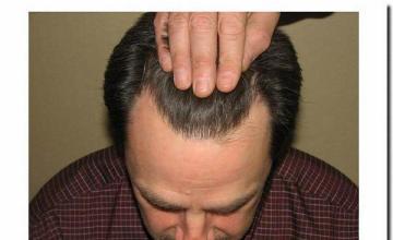 Hair restoration procedure results