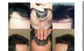 Hair restoration procedure results