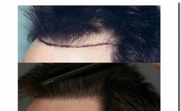 Hair restoration procedure results