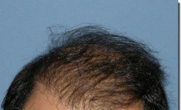 Hair restoration procedure results