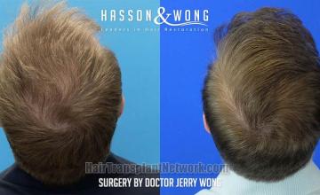 Surgical hair transplantation result photographs