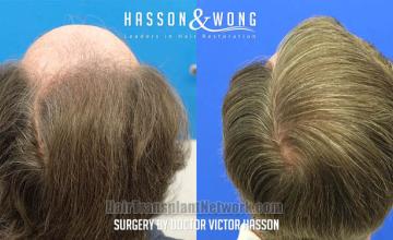 Surgical hair transplantation result photographs