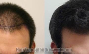 Hair transplantation surgery before and after images