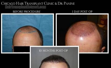 Hair restoration procedure before and after results