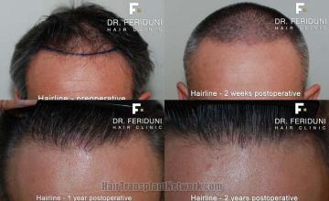 Hair transplantation surgery before and after pictures