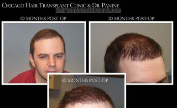 Hair transplant surgery ten months postoperative