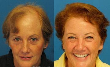 Hair transplantation surgery before and after photos