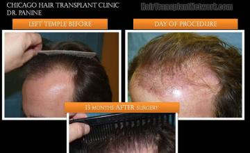 Hair transplantation surgery before and after photos