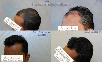 Hair transplantation surgery before and after pictures