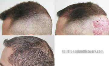 Hair transplantation surgery before and after photos