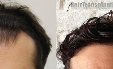 Hair transplantation surgery before and after pictures