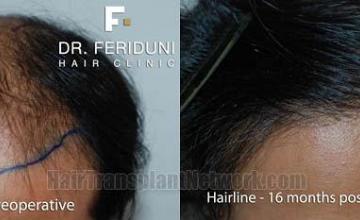 Hair restoration procedure before and after pictures