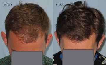 Hair restoration procedure before and after pictures