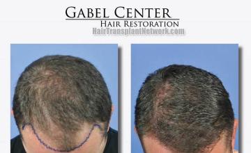 Top view - Before and after surgical hair replacement