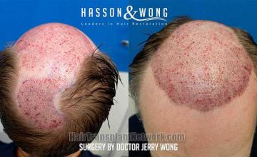 Hair restoration procedure before and after images