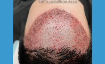 Hair transplantation surgery before and after pictures