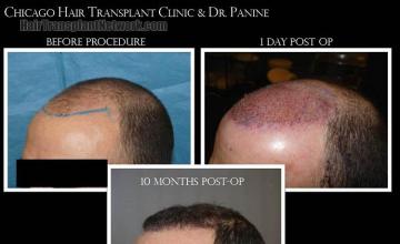 Hair transplantation surgery before and after images