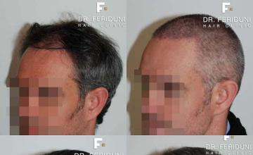 Hair restoration surgery before and after photos