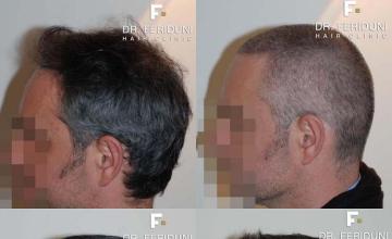 Hair transplantation surgery before and after photos