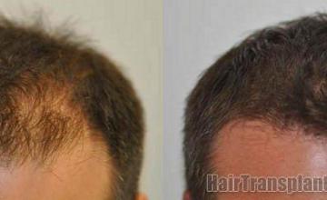 Before and after hair restoration photos