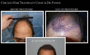 Hair transplantation surgery before and after images