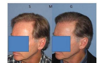 Left side hair transplant procedure photos