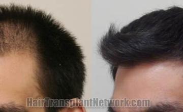 Hair restoration procedure before and after pictures