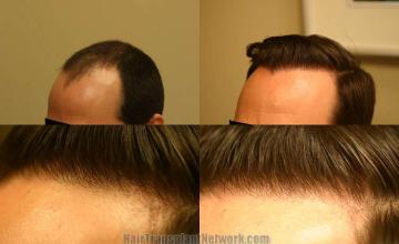 Hair transplantation surgery before and after photos