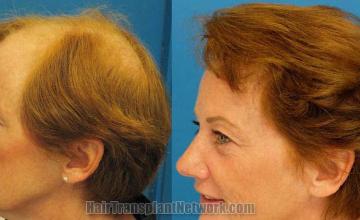 Hair restoration procedure before and after pictures