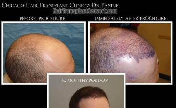 Hair transplantation surgery before and after photos