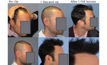 Hair transplantation surgery before and after images