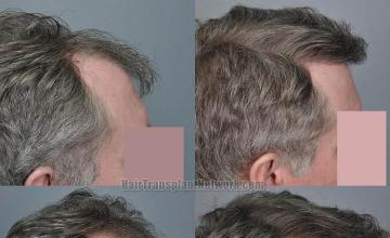 Hair transplantation surgery before and after pictures