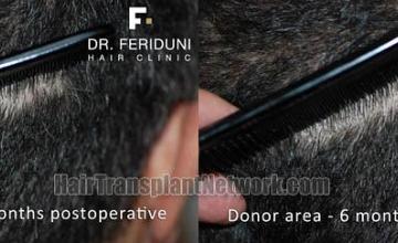 Hair restoration procedure before and after pictures