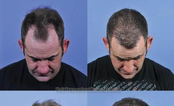 Hair restoration procedure before and after results