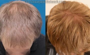 Hair transplantation surgery before and after photos