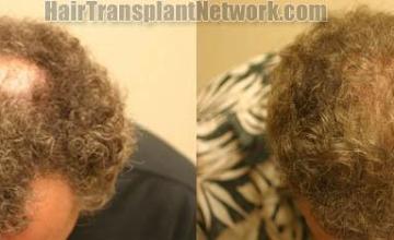 Top view before and after hair restoration results