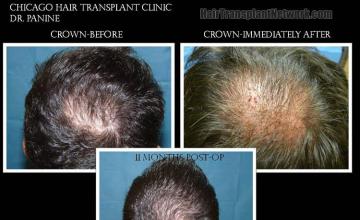 Back view before and after hair transplantation photos