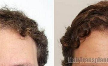 Front view photos- Before and after hair restoration