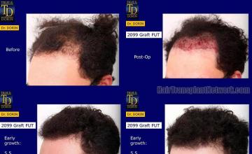 Hair transplantation surgery before and after images