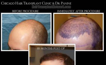 Hair transplantation surgery before and after images