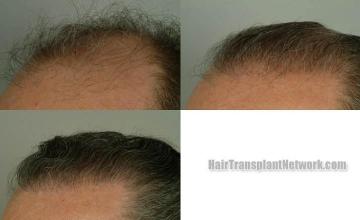 Hair transplantation surgery before and after pictures