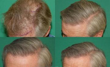 Hair transplantation surgery before and after images