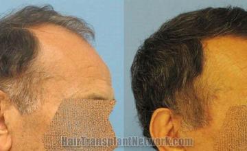 Right side views - Before and after hair replacement procedure